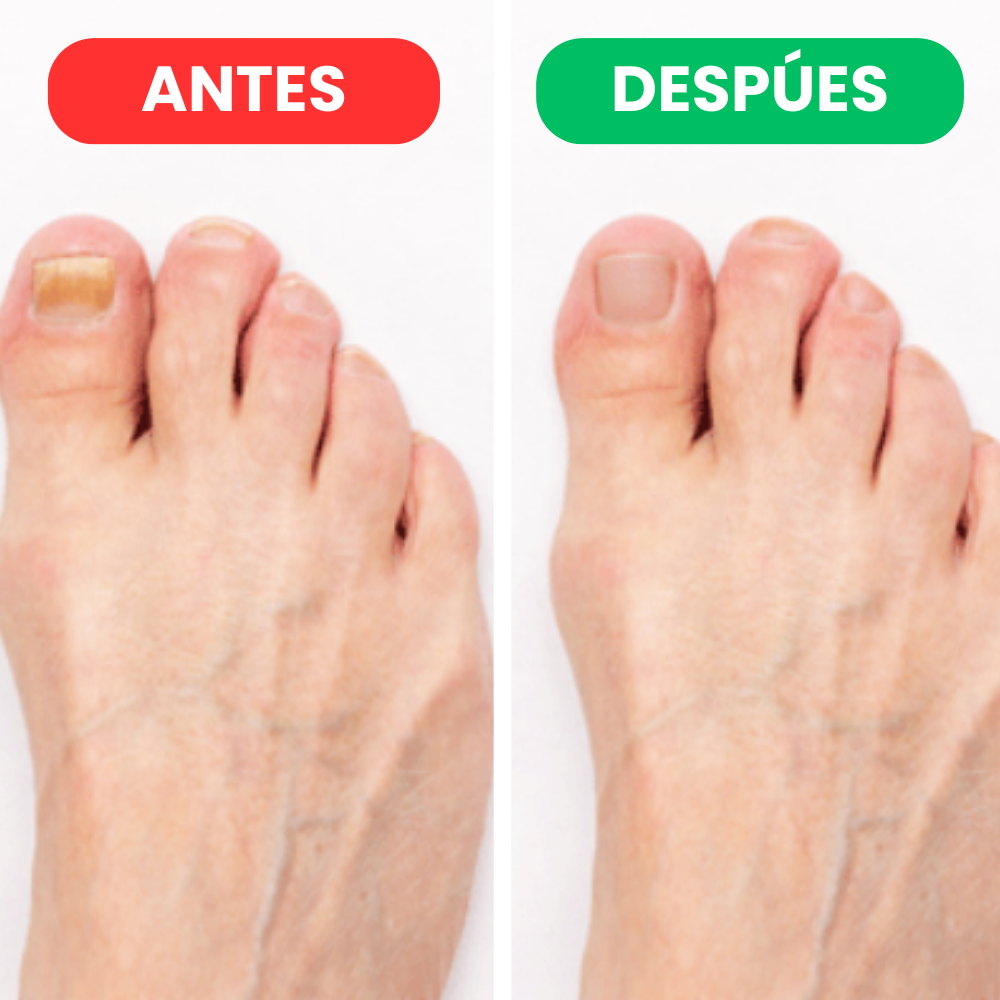 MEDINAIL- Protección esencial para la salud de tus uñas